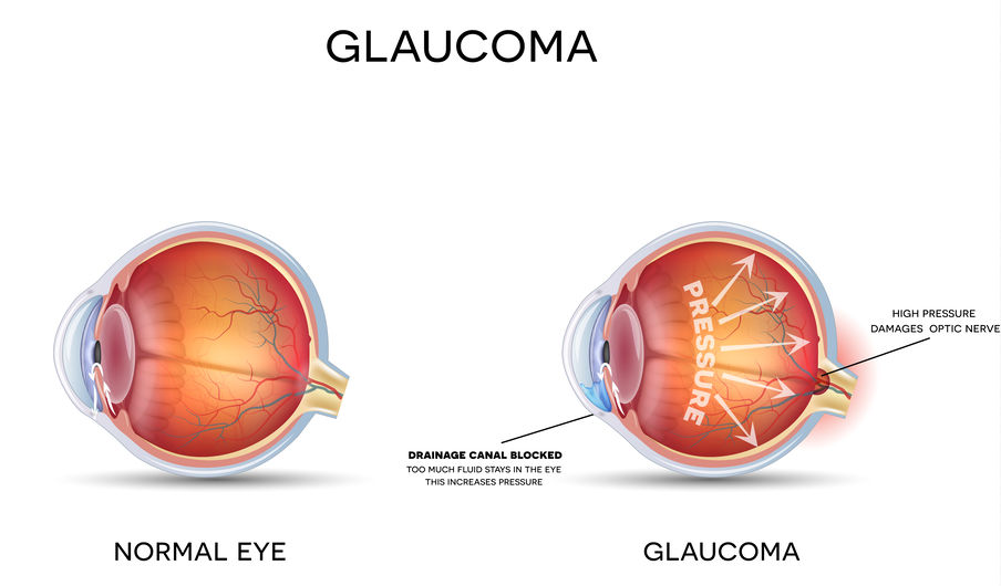 GLAUCOMA – Dr. Piantanida Como