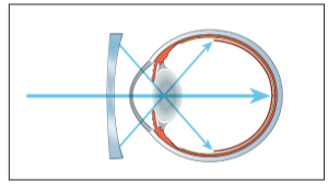 Correzione della miopia con lenti a defocus